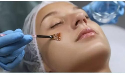 Chemicalpeel.jpeg Chemicalpeel.jpeg