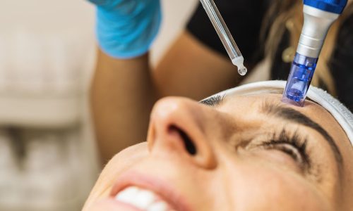 Microneedling