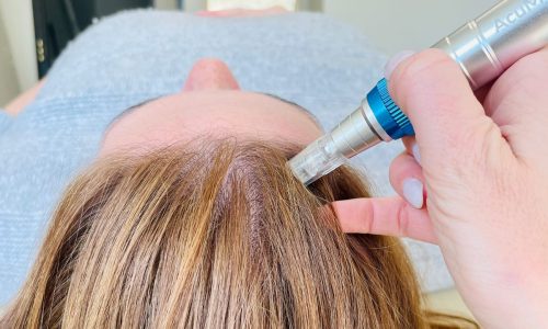 Microneedlingforhair