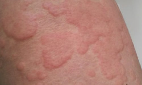 Urticaria